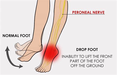 what is a drop in foot